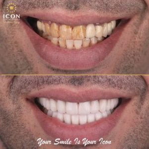 قبل وبعد ابتسامة هوليود