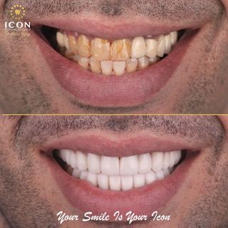 قبل وبعد ابتسامة هوليود