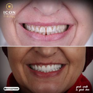 نتائج حالات عيادة ايقون قبل وبعد