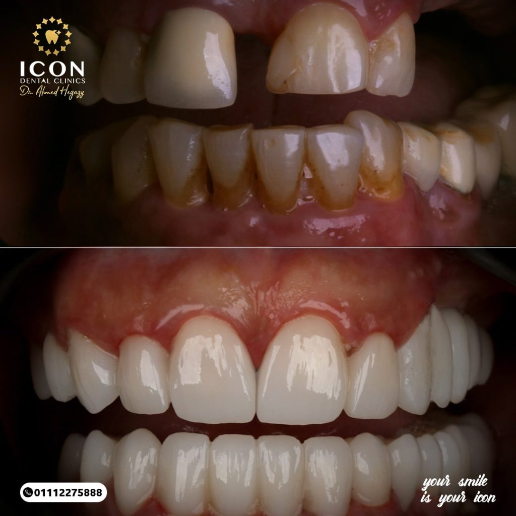 تحولات مدهشة لحالات عيادة ايقون قبل وبعد بإشراف الدكتور أحمد حجازى