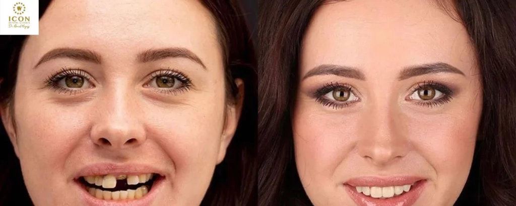 نتائج زراعة الأسنان