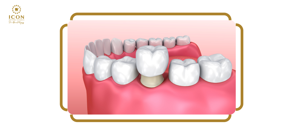 تركيبات الاسنان-تركيب اسنان