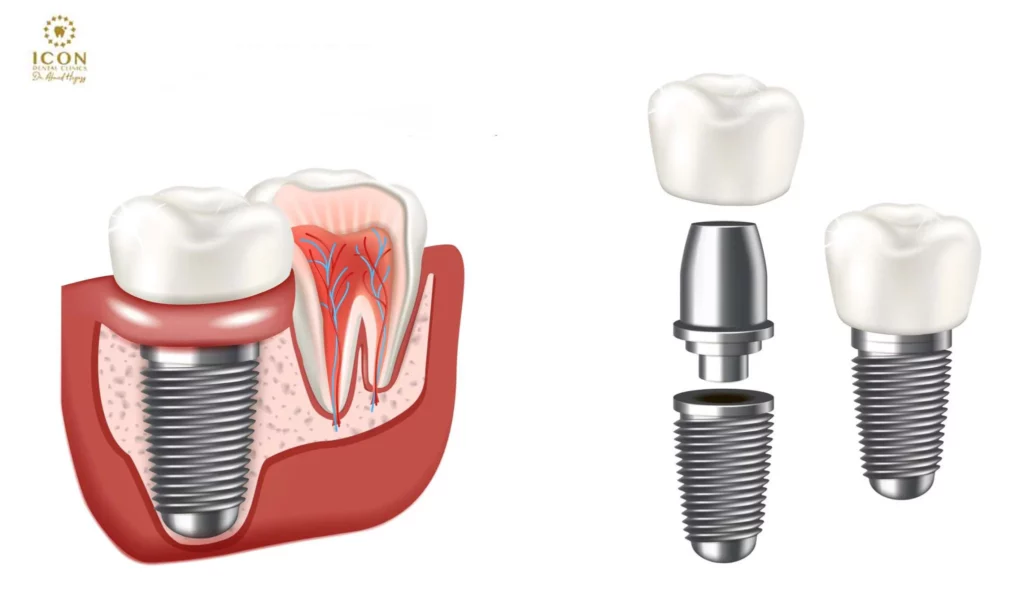 لماذا تتم زراعة الأسنان؟