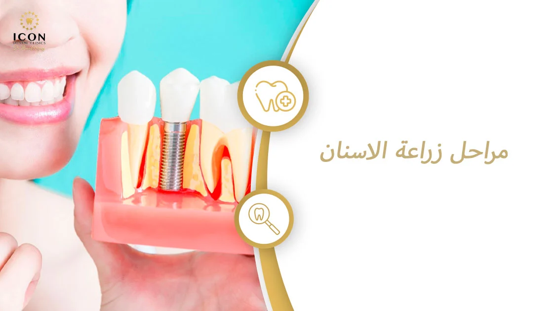 مراحل زراعة الأسنان
