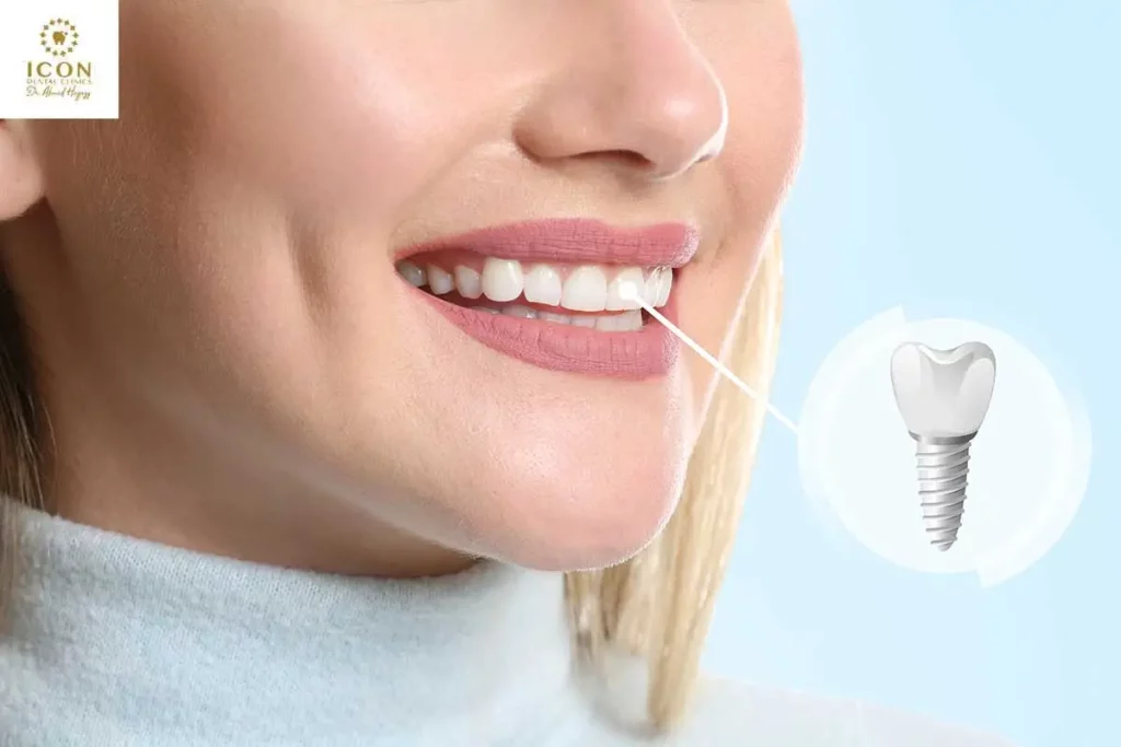 تجربتي مع زراعة الأسنان الفورية