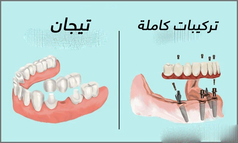 أنواع التركيبات الثابتة للأسنان