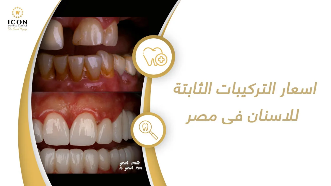 اسعار التركيبات الثابتة للاسنان فى مصر