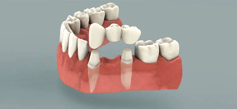 التركيبات الثابتة للأسنان
