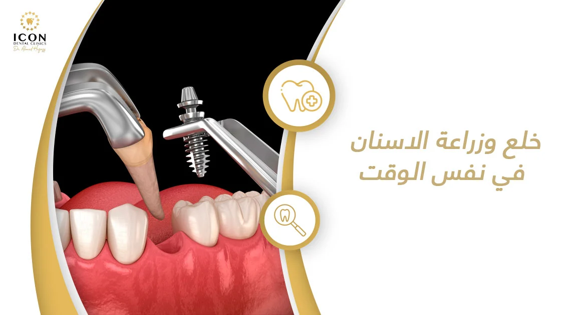 خلع وزراعة الاسنان في نفس الوقت