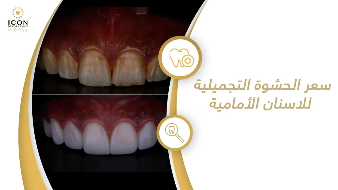 سعر الحشوة التجميلية للاسنان الأمامية