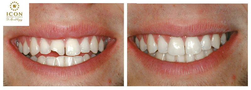 شكل حشو الأسنان الأمامية