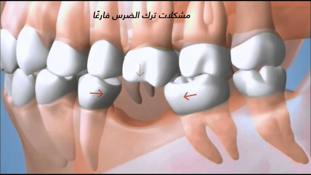 مشكلات ترك الضرس فارغًا