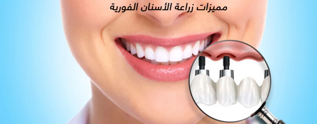 مميزات زراعة الأسنان الفورية