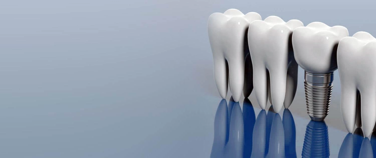 زرعات الاسنان